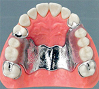 金属床義歯(メタルプレート)