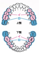 高強度硬質レジンブリッジ